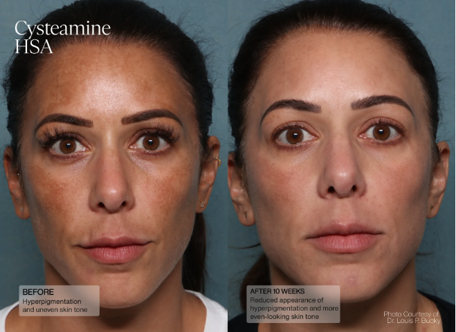 Cysteamine HSA Pigment & Tone Corrector image 2