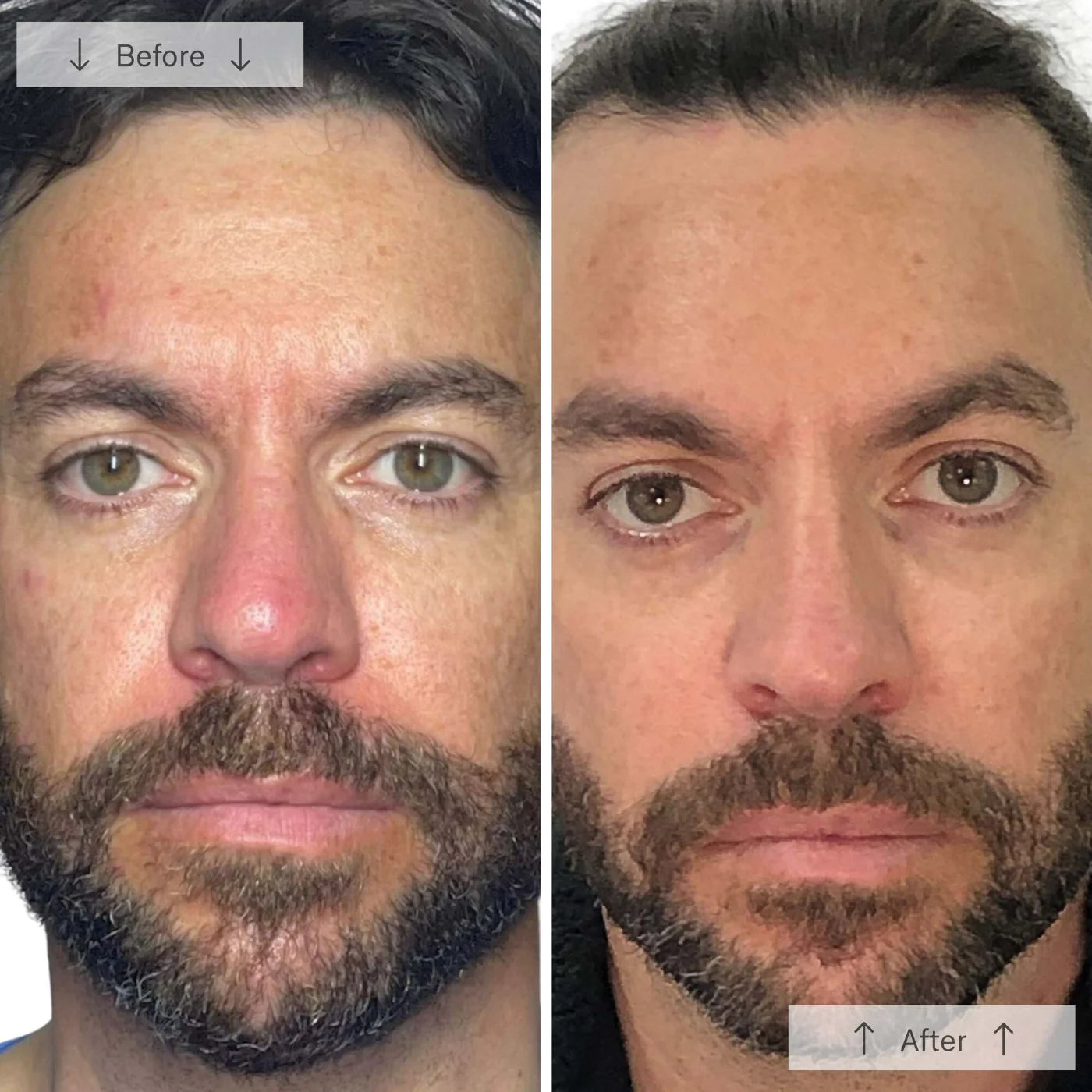 the Ultimate Regenerative Duo: INVO Regenerating Complex + Omnilux® LED Mask