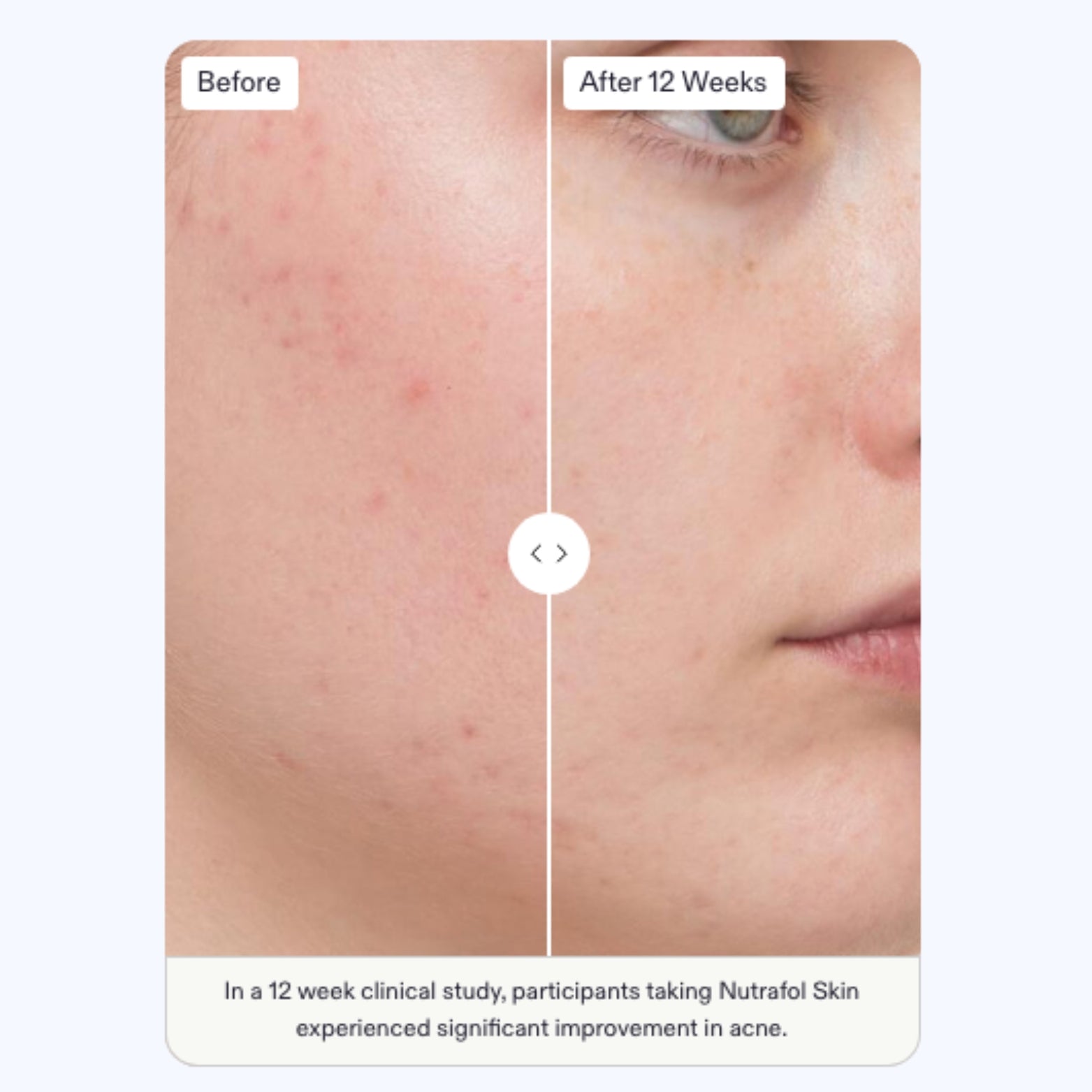 Omnilux+Nutrafol Skin Package