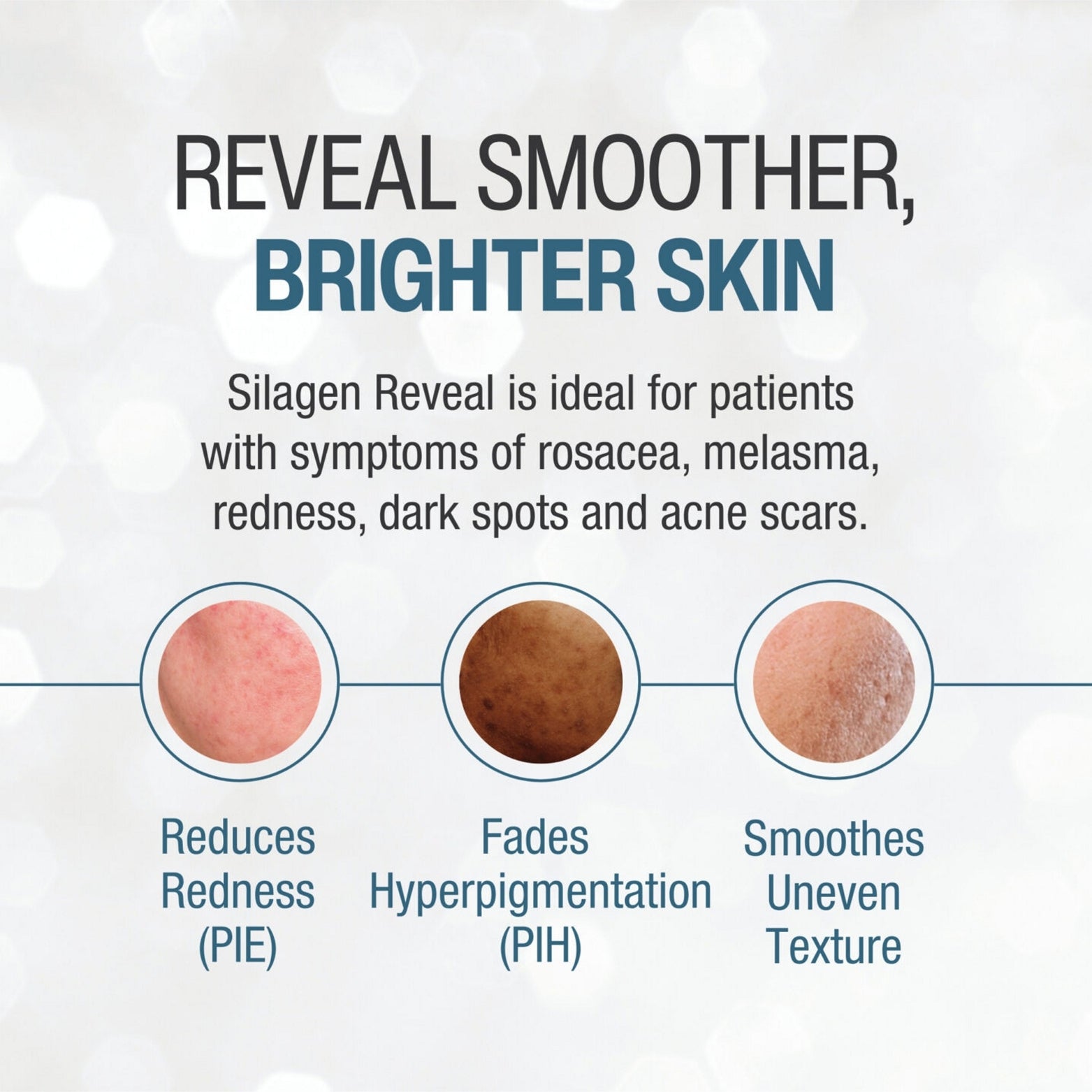Silagen® Reveal