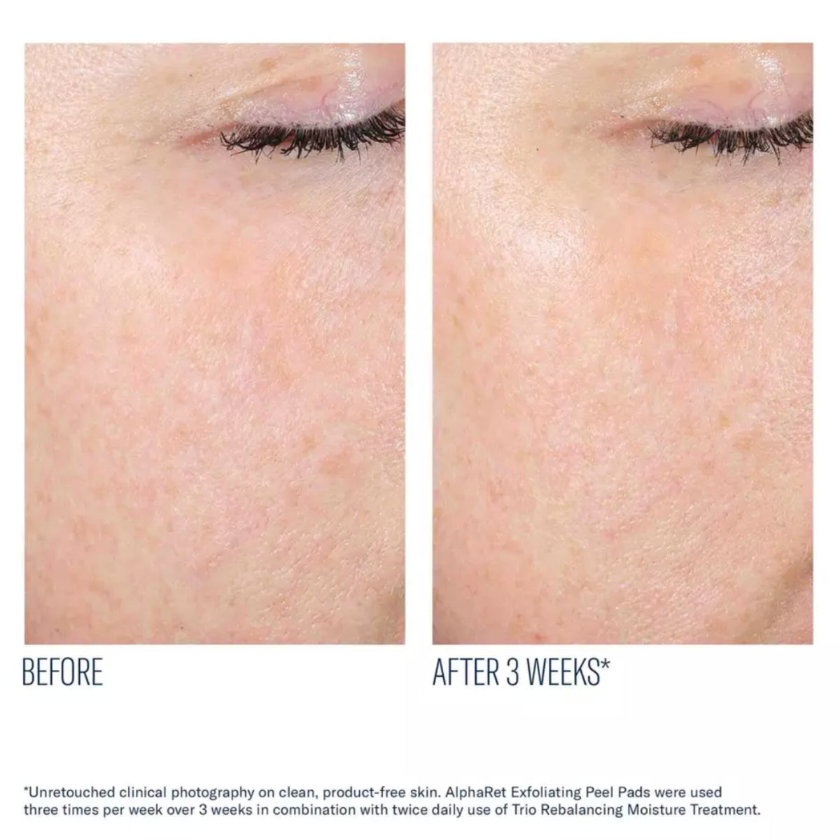skinbetter science™ AlphaRet Exfoliating Peel Pads